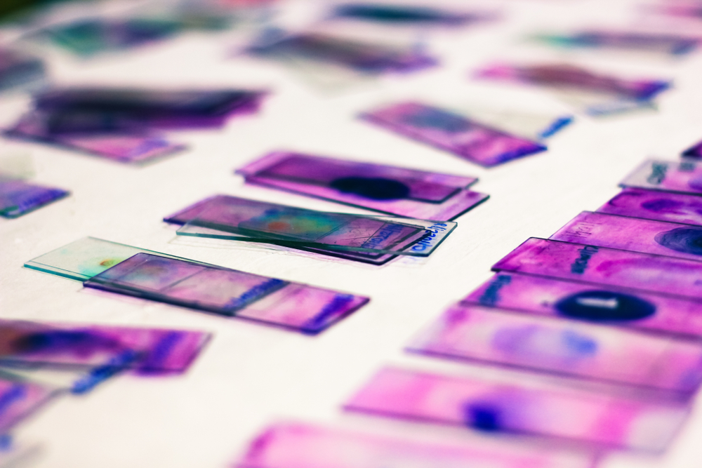 Black and Hispanic Patient Have An Increased Chance of Getting Staph Infections